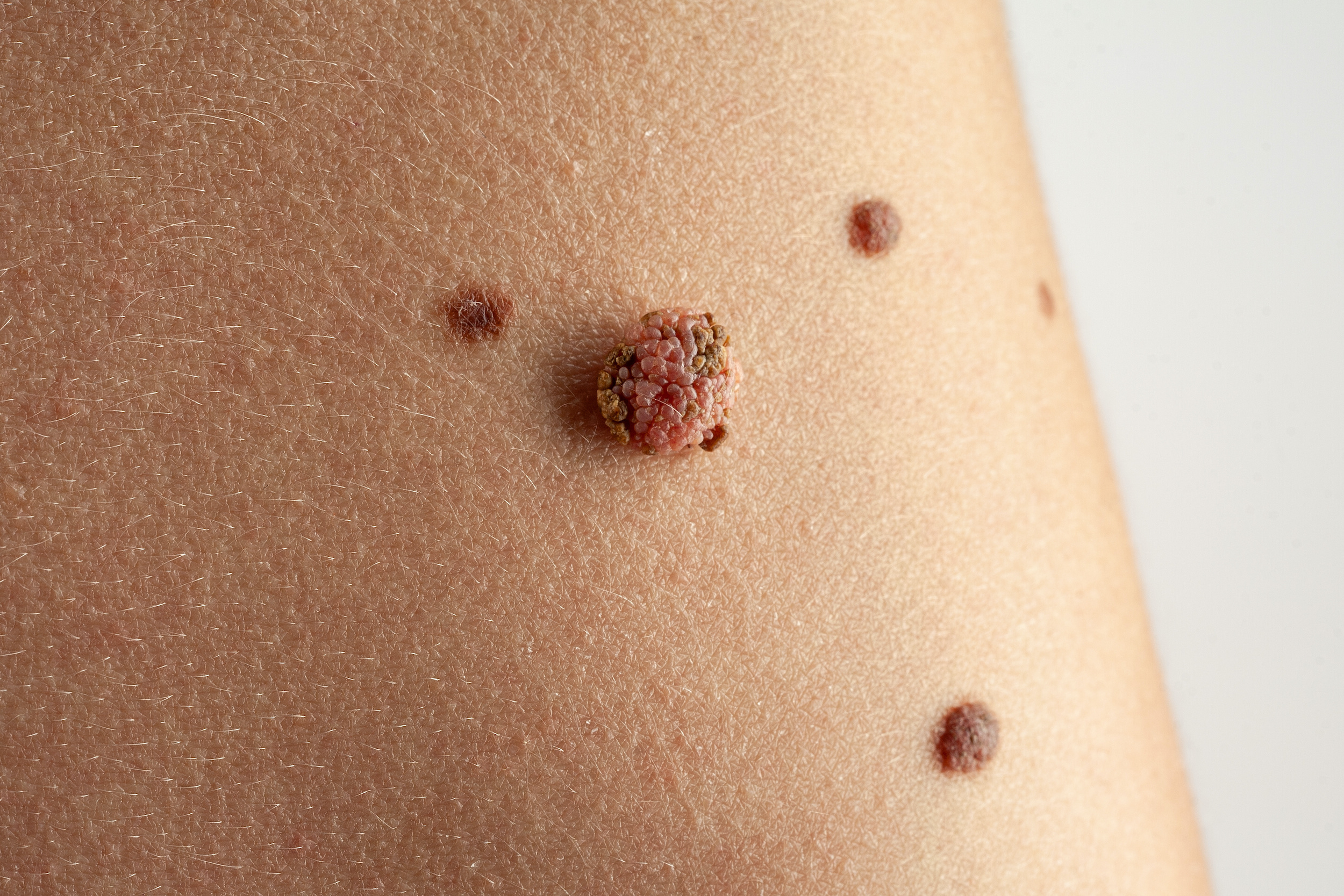 why-is-skin-cancer-on-the-rise-in-the-uk-how-to-cope-with-it