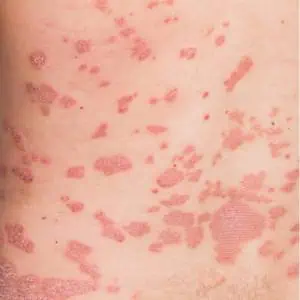 psoriasis pictures