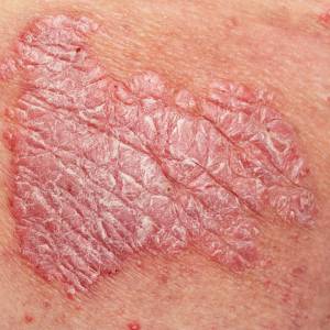 psoriasis treatment