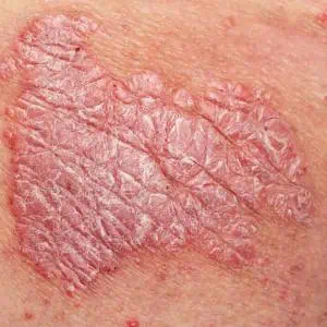 psoriasis treatment