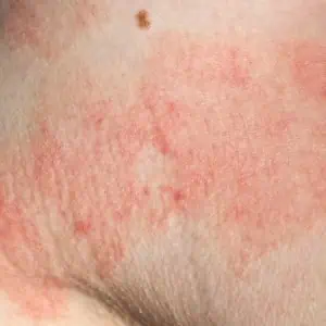 eczema on face images