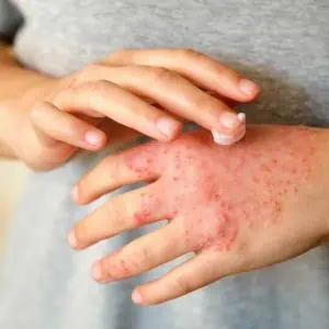 eczema on hands images