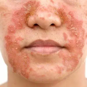 treatment for eczema