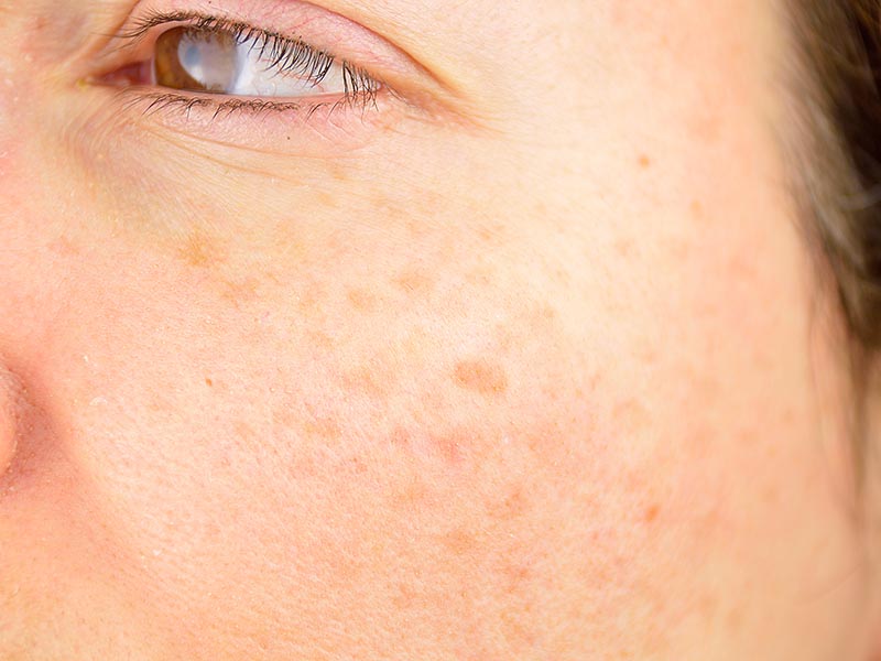 Freckles and Solar Lentigos | Harley Street Dermatology Clinic