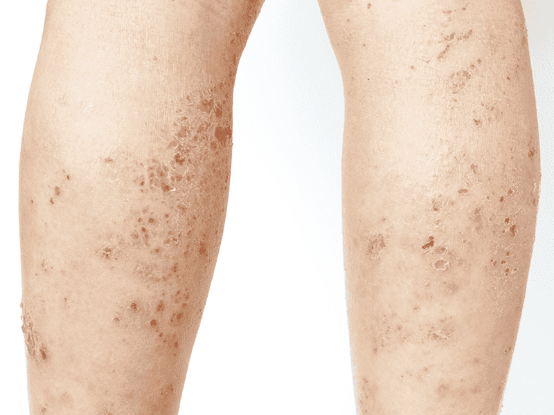 lichen sclerosus on legs
