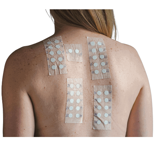 skin allergy patch test London