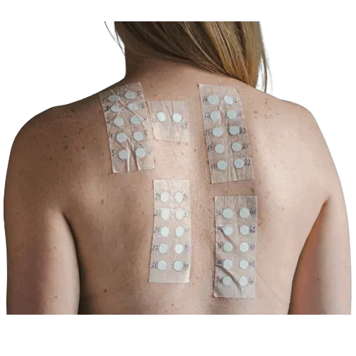 skin allergy patch test London