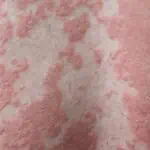 psoriasis awareness month psoriasis treatment