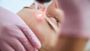 co2 laser resurfacing london