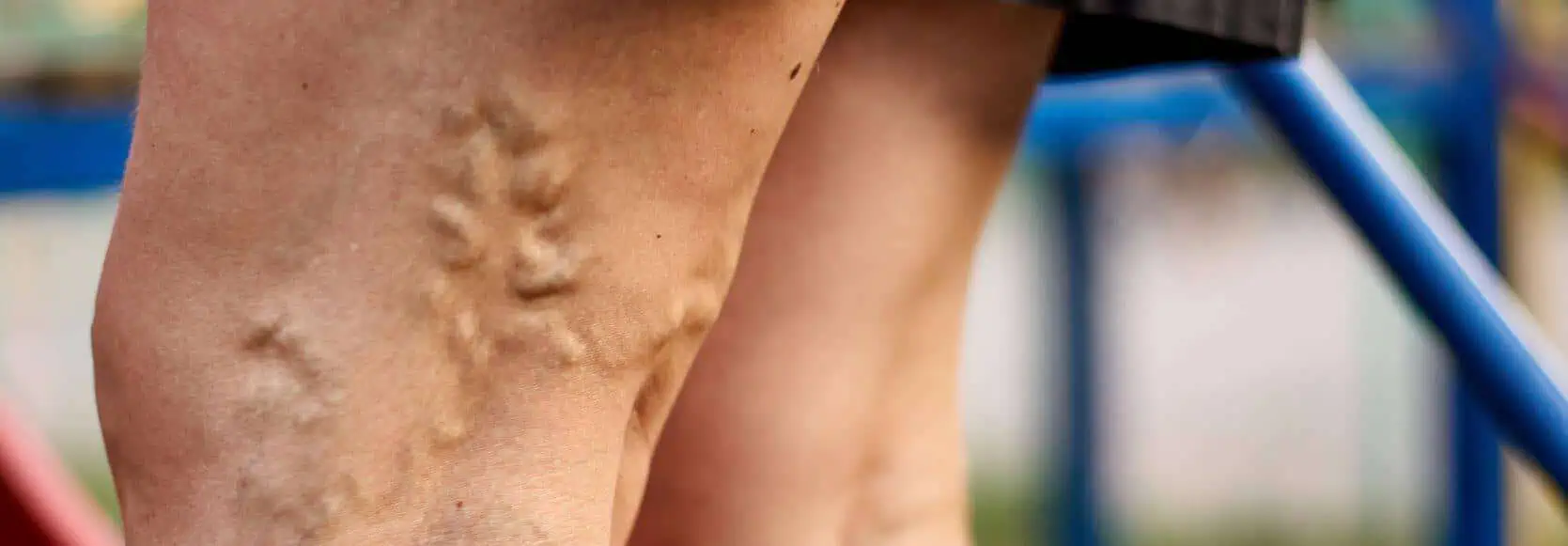 Varicose veins